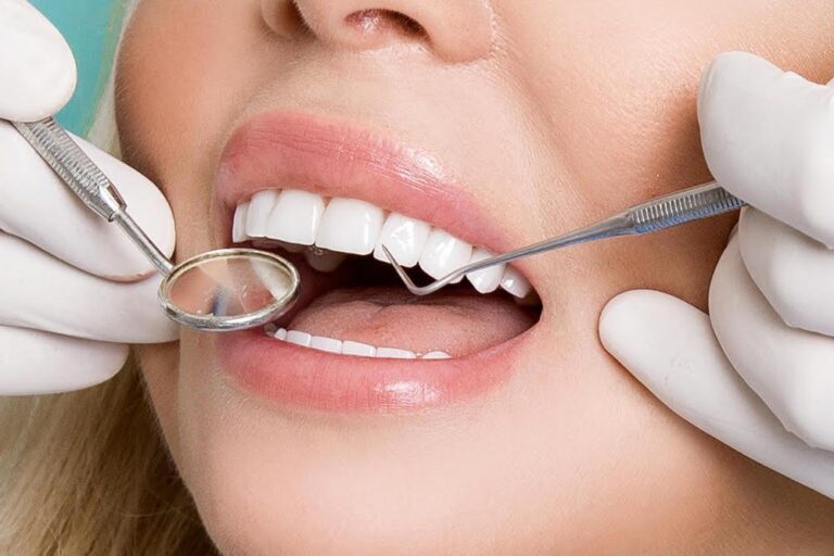 Veneers